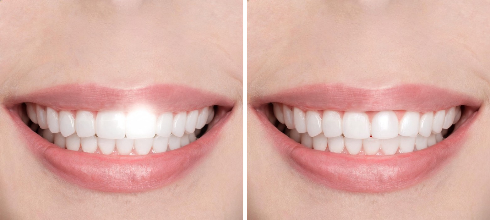 Before and after: AI-generated smile photo with a bright ring-flash specular glare on the front teeth, then the same photo after an enhance_asset_proxy recraft-inpaint fix restoring natural enamel texture
